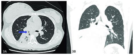 A Showing An Endobronchial Lesion In The Right Mainstem B Showing An