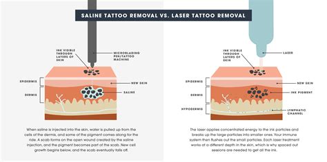 Tattoo Removal Pros And Cons Home Design Ideas