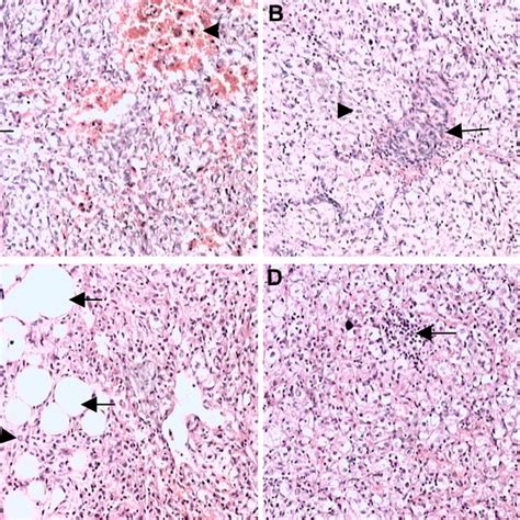 Microscopic Appearances Of Hepatic Perivascular Epithelioid Cell Tumor