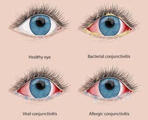 Weitere virale konjunktivitiden kommen unter anderem vor bei varizellen, zoster ophthalmicus, influenza, röteln, mumps, masern, zytomegalie und infektiöser mononukleose. Pink eye: Viral, bacterial and allergic conjunctivitis ...