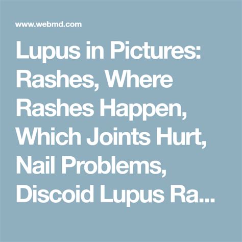 A Visual Guide To Lupus Discoid Lupus Nail Problems Lupus