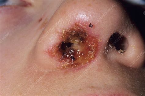 Redness, swelling and tenderness are the initial signs of an infection. Nasal infection - Stock Image - M290/0144 - Science Photo ...