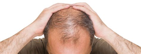 Telogen effluvium — this common form of hair loss happens two to three months after a major body stress, such as a prolonged illness, major surgery or serious infection. What You Need to Know About Laser Treatments for Hair Loss ...
