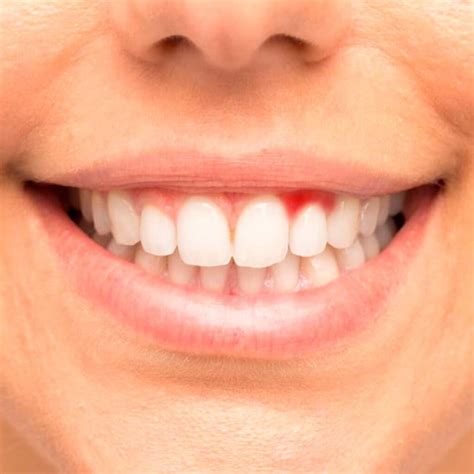 ¿por Qué Tienes Las Encías Inflamadas Y Cuál Es El Tratamiento Más Adecuado • Clínica Dental