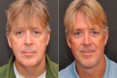 Minilift Facelift Photos Cincinnati Facial Plastic Surgery