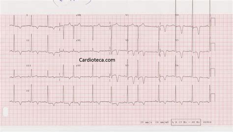 La miocardite è un'infiammazione del muscolo cardiaco in genere associata a infezioni virali, batteriche o fungine rx del torace. Curso ECG: Miocardiopatía hipertrófica