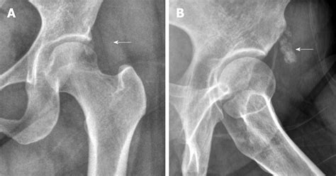 Ultrasonographic Evaluation Of The Effect Of Extracorporeal Shock Wave Therapy On Calcific