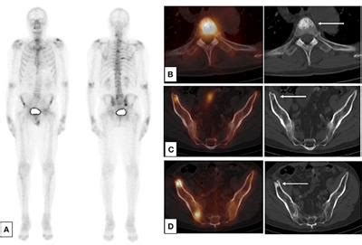 Frontiers Imaging For Metastasis In Prostate Cancer A Review Of The Literature