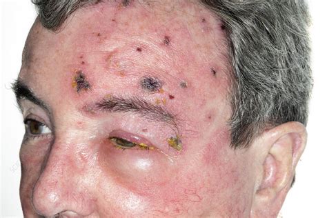 If you'd like to support us and get something great in return, check out our pdf osce checklist booklet containing has positive nikolsky sign. Shingles rash on the face - Stock Image - C021/3403 ...