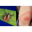 Next Generation Lyme Disease Tests Found Efficacious And Ready For 