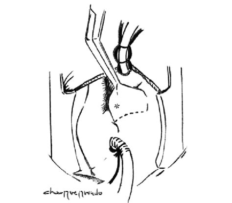 Diagram Shows The Aortic Valve Exposure Through A Traditional