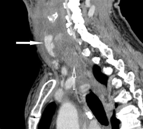 Spontaneous Cervical Haematoma Caused By Extracapsular Haemorrhage From