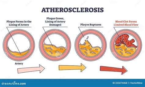 Atherosclerosis Stages Explanation And Fatty Plaque Formation Outline