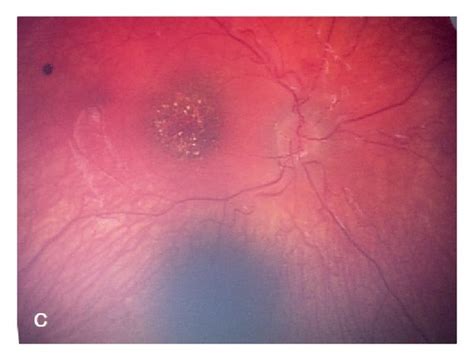 Retcam Images A Right Eye B Left Eye Bilateral Optic Disc