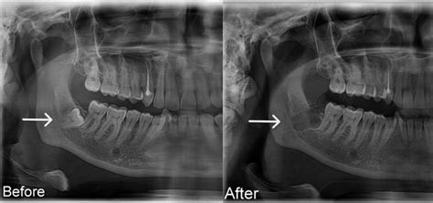 Wisdom Tooth Removal The Dental Roots