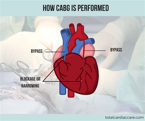How Is Cabg Performed Total Cardiac Care Drmahadevan