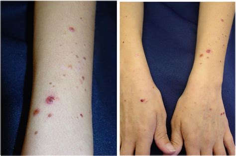 Bullous Diseases Kids Are Not Just Little People Clinics In Dermatology