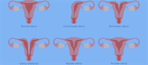 Uterine Abnormalities Total Fertility