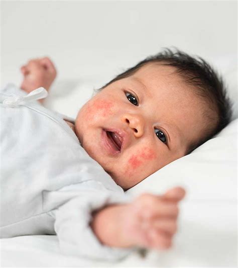 Baby Rashes Causes Types Treatments And Prevention Tips