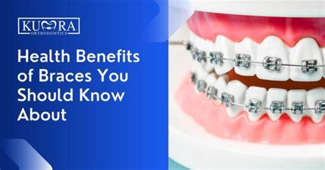 Health Benefits Of Braces You Should Know About Kumra Orthodontics