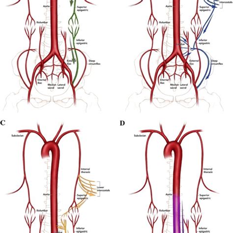 Visceral Collateral Pathways In Aortoiliac Occlusive Disease The