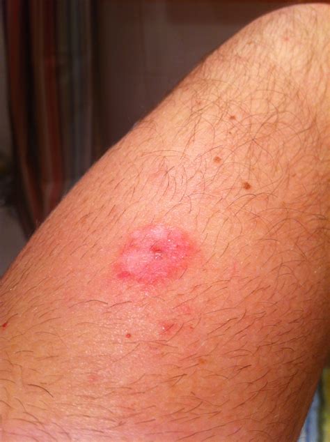 Rash On Upper Arm Pictures Photos