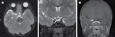 Morning Glory Disc Anomaly In Association With Ipsilateral Optic Nerve Glioma Neuro Oncology