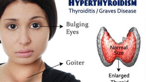 Thyroid A Complete Guide
