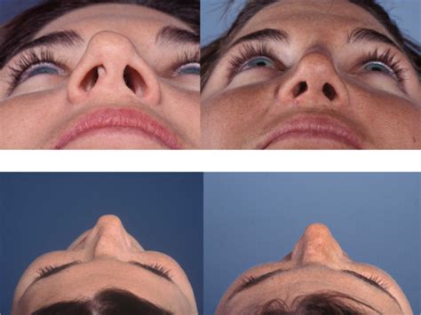 Rhinoplasty Crooked Nose By Dr David Sherris In Buffalo New York