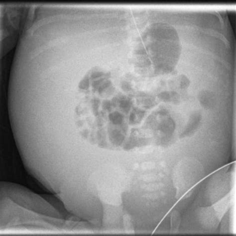 Postnatal X Ray A P View Of The Abdominal Cavity Confirming Ascites