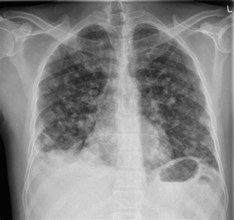Lung Metastasis Case 002 • Litfl • Lung Ultrasound Library
