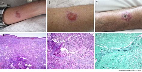 Pyoderma Gangrenosum And Primary Cutaneous Cryptococcosis In An