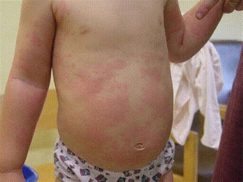 Urticaria Hives Children