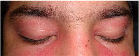 Heliotrope Rash On Eyes