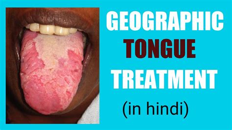 जीभ पर नक़्शे जैसा पैटर्न बनना Geographic Tongue Causes Homeopathic