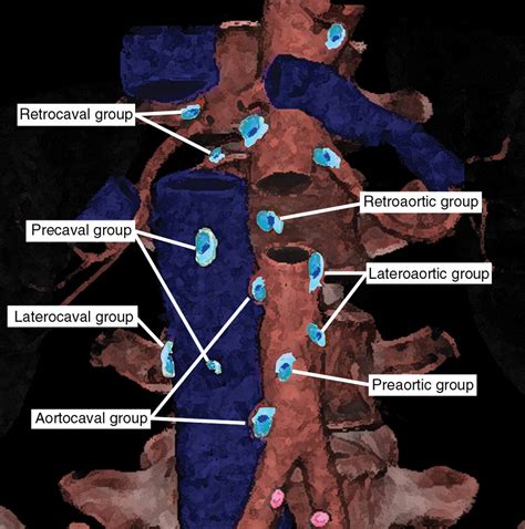 Pathways Of Lymphatic Spread In Male Urogenital Pelvic Malignancies