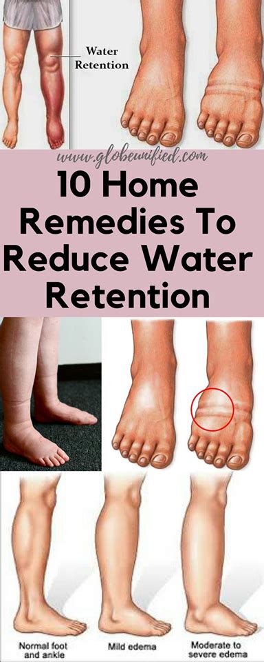 10 Home Remedies To Reduce Water Retention Water Retention Remedies