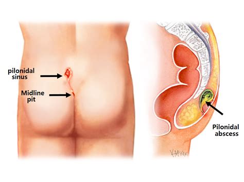 Pilonidal disease is a chronic disease of the natal cleft. Pilonidal Sinus | Colorectal Surgeons Sydney