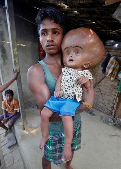 Roona Begum Giant Head Baby Can See Move After Drastic Skull