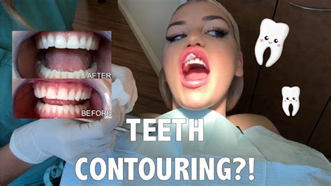 I Got My Teeth Contoured Youtube