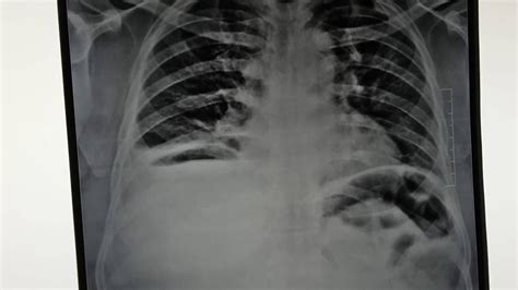 Air Under Diaphragm X Ray