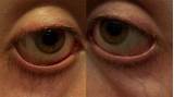 Hollow Eyes Home Remedies Photos