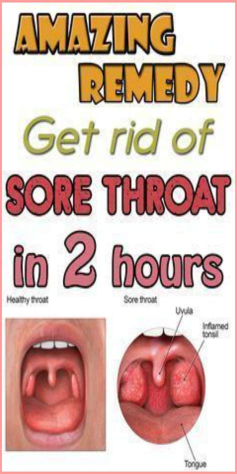 Home Remedies For Sore Throat Wellness Treats