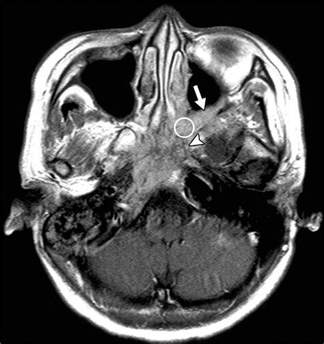 Mri And Ct Of Nasopharyngeal Carcinoma Ajr