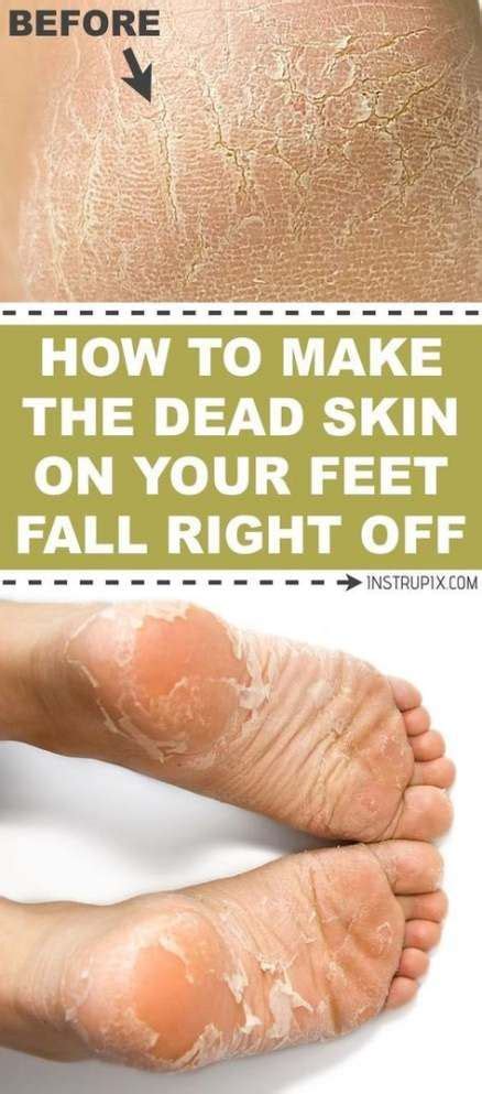 Well, the skin on your feet is waaay thicker than the other areas of the body, so you need a specialized cream to target those hard and dry patches. Super Pedicure Diy Dead Skin Cracked Feet Foot Soaks 24 ...