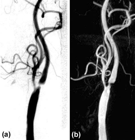 Internal Carotid Artery Stenosis Measurement Stroke