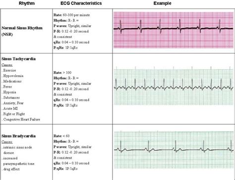 80 Best Images About Acls On Pinterest Ventricular