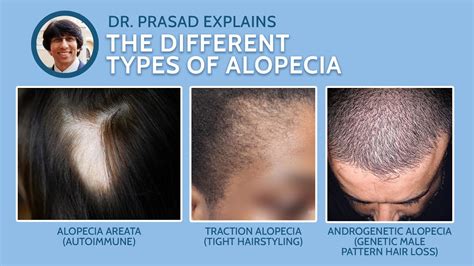 Why The Term Alopecia Is Not Just One Hair Loss Condition Youtube