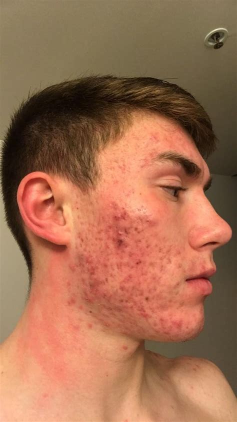 Severe Cystic Acne I Need Help Racne