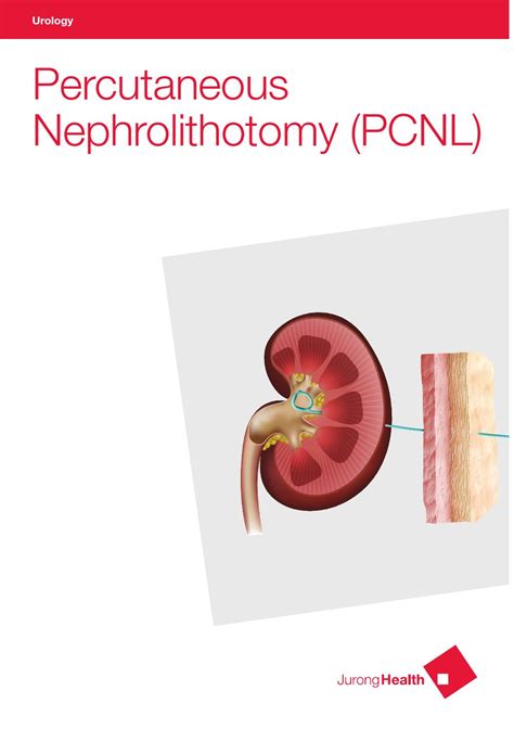 Urology Percutaneous Nephrolithotomy Pcnl By Juronghealth Campus